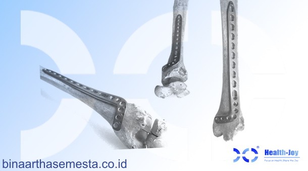 Heng-Jie Ankle & Distal Tibial - Pergelangan kaki & Tibia Distal 002